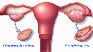 Nụ cười của những người phụ nữ ung thư buồng trứng