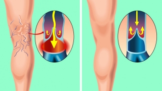 Cách làm giảm tình trạng giãn tĩnh mạch