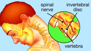 9 biện pháp khắc phục có thể giúp bạn tạm biệt chứng đau cổ