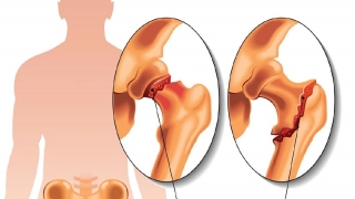 Chăm sóc và dự phòng bệnh loãng xương ở người cao tuổi