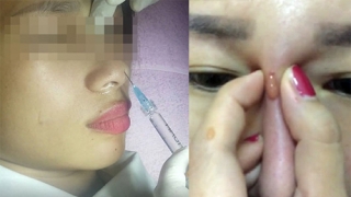 Cảnh báo tình trạng biến chứng nặng do tiêm filler để làm đẹp