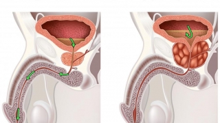 Nam y điều trị phì đại lành tính tuyến tiền liệt và ung thư tuyến tiền liệt