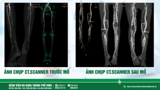 Nghệ An ứng dụng thành công phương pháp tưới máu ngược dòng tránh việc cắt cục chi ở bệnh nhân tổn thương mạch máu do đái tháo đường