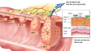 Tìm hiểu các giai đoạn tế bào ung thư di căn