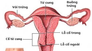 Phòng chống ung thư cổ tử cung