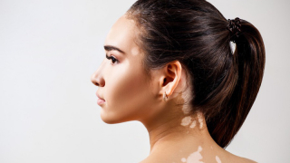 Điều trị bệnh bạch biến bằng Nam y
