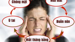 Y học cổ truyền điều trị rối loạn tiền đình nên hay không?