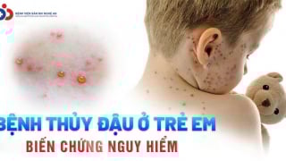Bệnh viện Sản Nhi Nghệ An điều trị thành công cho bé sơ sinh 15 ngày tuổi bị thủy đậu biến chứng ác tính