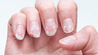 Bổ sung vitamin và khoáng chất nào khi móng tay giòn, dễ gãy?