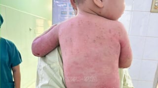 Bé trai 2 tuổi bị bỏng 60% được cứu sống ngoạn mục nhờ mẹ hiến da
