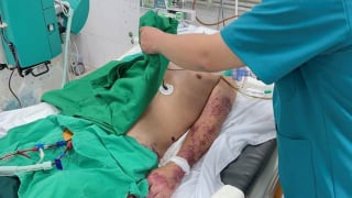 Bộ Y tế khuyến cáo 6 cách phòng, chống bệnh liên cầu lợn