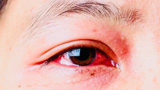 Cảnh giác với đau mắt đỏ: Dấu hiệu sớm và biện pháp phòng ngừa hiệu quả