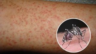 Dự báo gia tăng ca mắc sốt xuất huyết ở Hà Nội