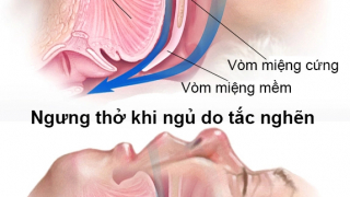 Đừng chủ quan với hội chứng ngừng thở khi ngủ