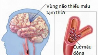 Mọi người không nên xem thường thiếu máu não cục bộ tạm thời