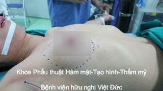 Nam thanh niên phẫu thuật cắt bỏ tuyến vú do bị hội chứng vú to nam giới