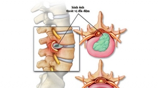Phẫu thuật thoát vị đĩa đệm bao lâu thì khỏi?