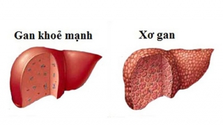 Những thực phẩm ngăn ngừa xơ gan hiệu quả