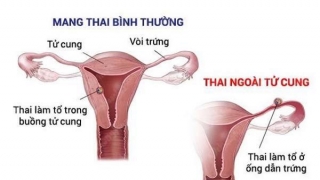 Nguyên nhân mang thai ngoài tử cung