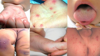 Gọi là bệnh Tay Chân Miệng hay là Chân Tay Miệng
