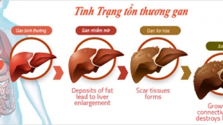 4 nguyên tắc quan trọng giúp phòng ngừa xơ gan hiệu quả