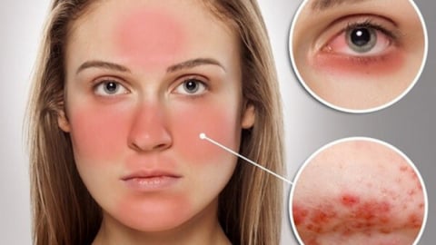 Lupus ban đỏ hệ thống: Biểu hiện đa dạng và thách thức trong chẩn đoán và điều trị
