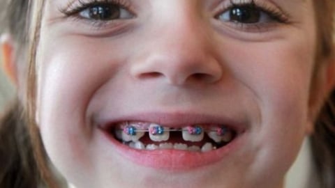 Vì sao giới trẻ Việt đua nhau niềng răng?
