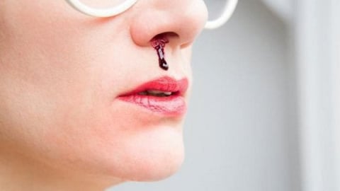 Chảy máu cam mùa hè: Nguyên nhân và cách phòng ngừa hiệu quả
