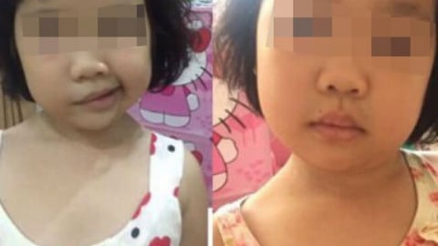 Tê liệt dây thần kinh số 7: Nhận biết sớm, điều trị kịp thời