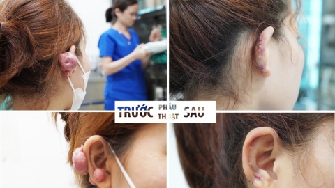 Phú Thọ: Phẫu thuật cắt bỏ sẹo lồi và tạo hình vành tai thành công cho người bệnh nữ 18 tuổi