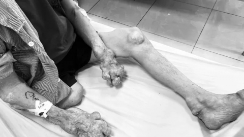 Bắc Giang: Điều trị cho 1 nam bệnh nhân bị biến chứng nhiễm trùng hạt tophi nặng nề do bệnh gout gây ra