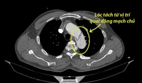 Phú Thọ: Áp dụng kỹ thuật Hybrid cứu sống người bệnh nặng do lóc tách động mạch chủ ngực