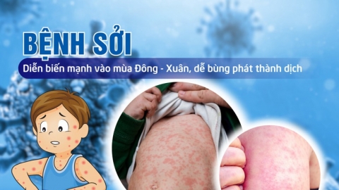 Thủ tướng yêu cầu tăng cường công tác phòng, chống bệnh sởi