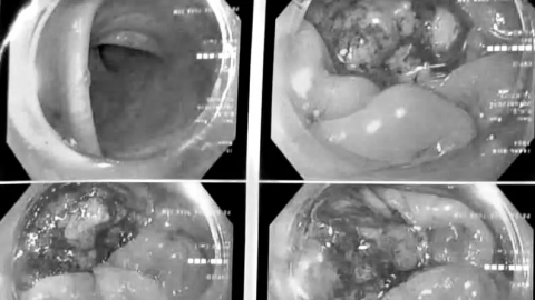 Quảng Ninh: Nhiều người phát hiện mắc ung thư đại tràng khi tuổi còn rất trẻ