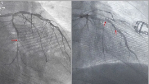 Quảng Ninh: Kịp thời sốc điện cấp cứu, can thiệp đặt stent khẩn cấp để cứu sống bệnh nhân ngừng tim nguy kịch