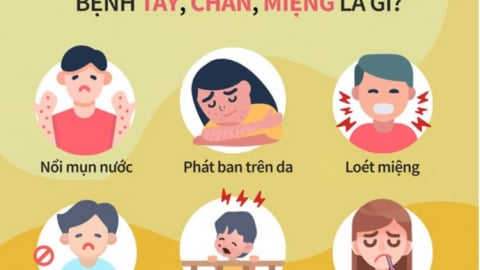 Infographics: Cần làm gì khi dịch tay chân miệng bùng phát trong trường học?