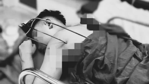 Hà Nội: Cấp cứu nam thanh niên 17 tuổi bị dị vật đâm xuyên thấu tim