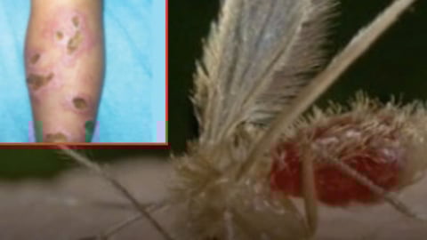 Thái Lan: Cảnh báo bệnh nhiễm ký sinh trùng Leishmania gây tử vong