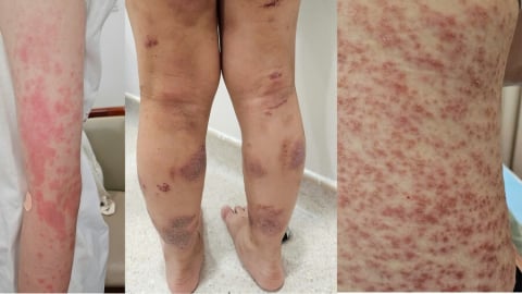 Chuyên gia cảnh báo mối nguy đe dọa tính mạng của bệnh miễn dịch, dị ứng