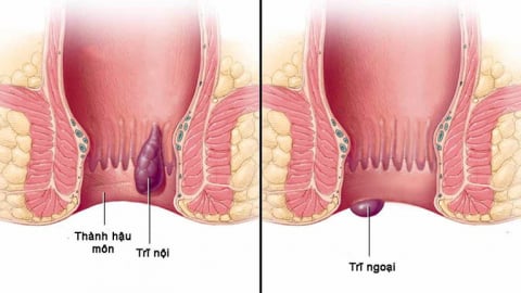 Hiểu đúng về bệnh trĩ để phòng ngừa hiệu quả
