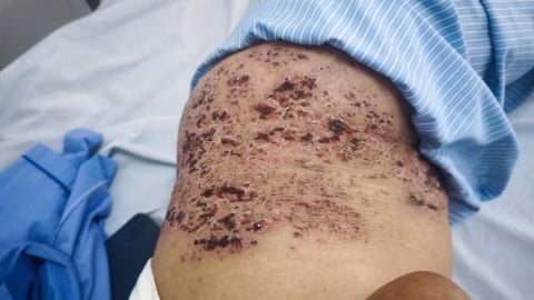 Hà Nội: Tiếp nhận nữ bệnh nhân 73 tuổi da bị lỗ chỗ như tổ ong vì đắp đậu xanh chữa zona thần kinh