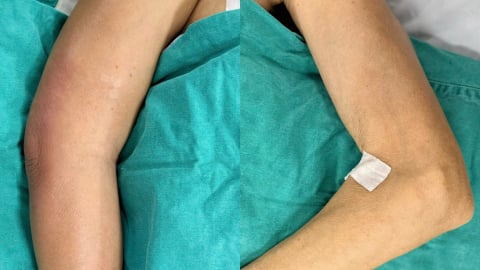 Hà Nội: Nữ bệnh nhân sốc nhiễm khuẩn nặng sau tiêm khớp vai tại phòng khám tư