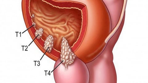 Bài thuốc hỗ trợ điều trị bệnh ung thư bàng quang