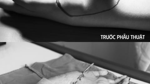 Hà Nội: Phẫu thuật thành công, giữ lại cổ bàn tay cho bệnh nhân ung thư hiếm gặp
