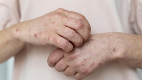 5 bệnh về da thường gặp ở trẻ mùa nắng nóng