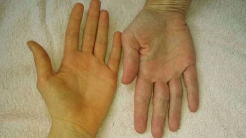 Vàng da là dấu hiệu của bệnh gì?