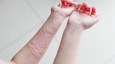 Nổi mề đay: Cách giảm ngứa tại nhà hiệu quả