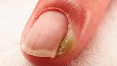 Thực hư cắt móng tay quá ngắn có nguy cơ bị bệnh tim?