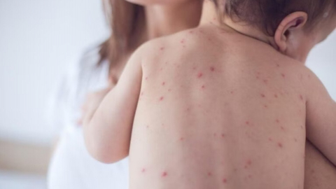 Sởi - Bệnh truyền nhiễm nguy hiểm ở trẻ em
