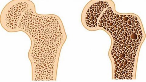 5 cơn đau nào là dấu hiệu của bệnh loãng xương?